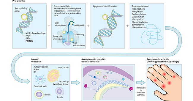 類風(fēng)濕性關(guān)節(jié)炎的發(fā)病途徑